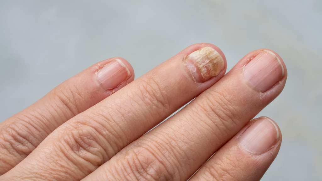 unghii cu ciupercă tratament naturist cum scapi de ciuperca unghiei acasă tratament unghii îngălbenite picioare